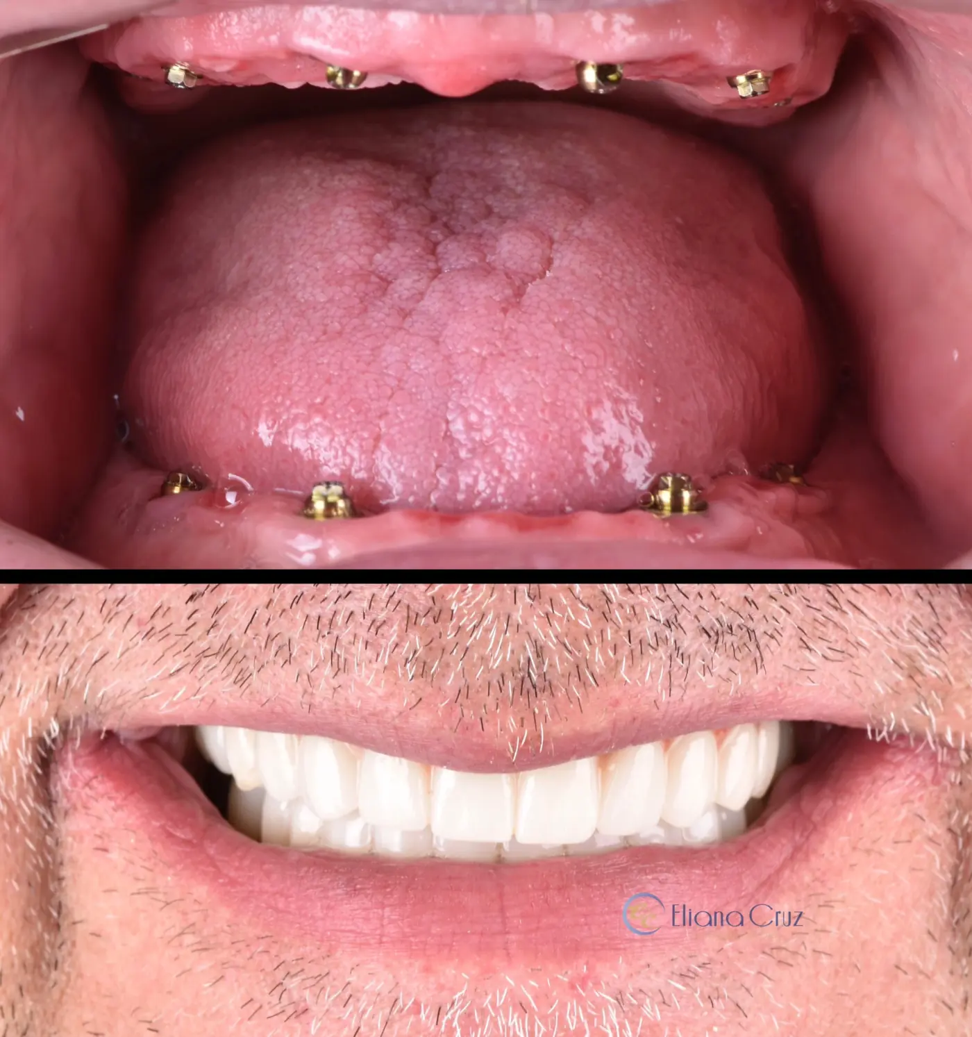 Antes y después de prótesis híbridas cerámicas superior e inferior