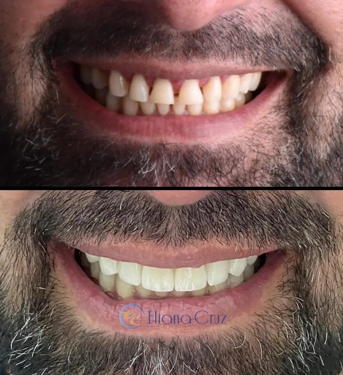 Antes y después de diseño de sonrisa con carillas cerámicas después de ortodoncia