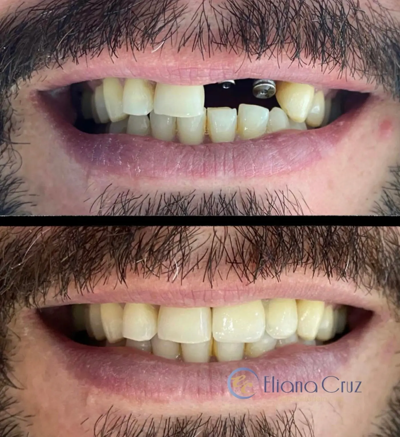 Antes y después de dos coronas sobre implantes dentales