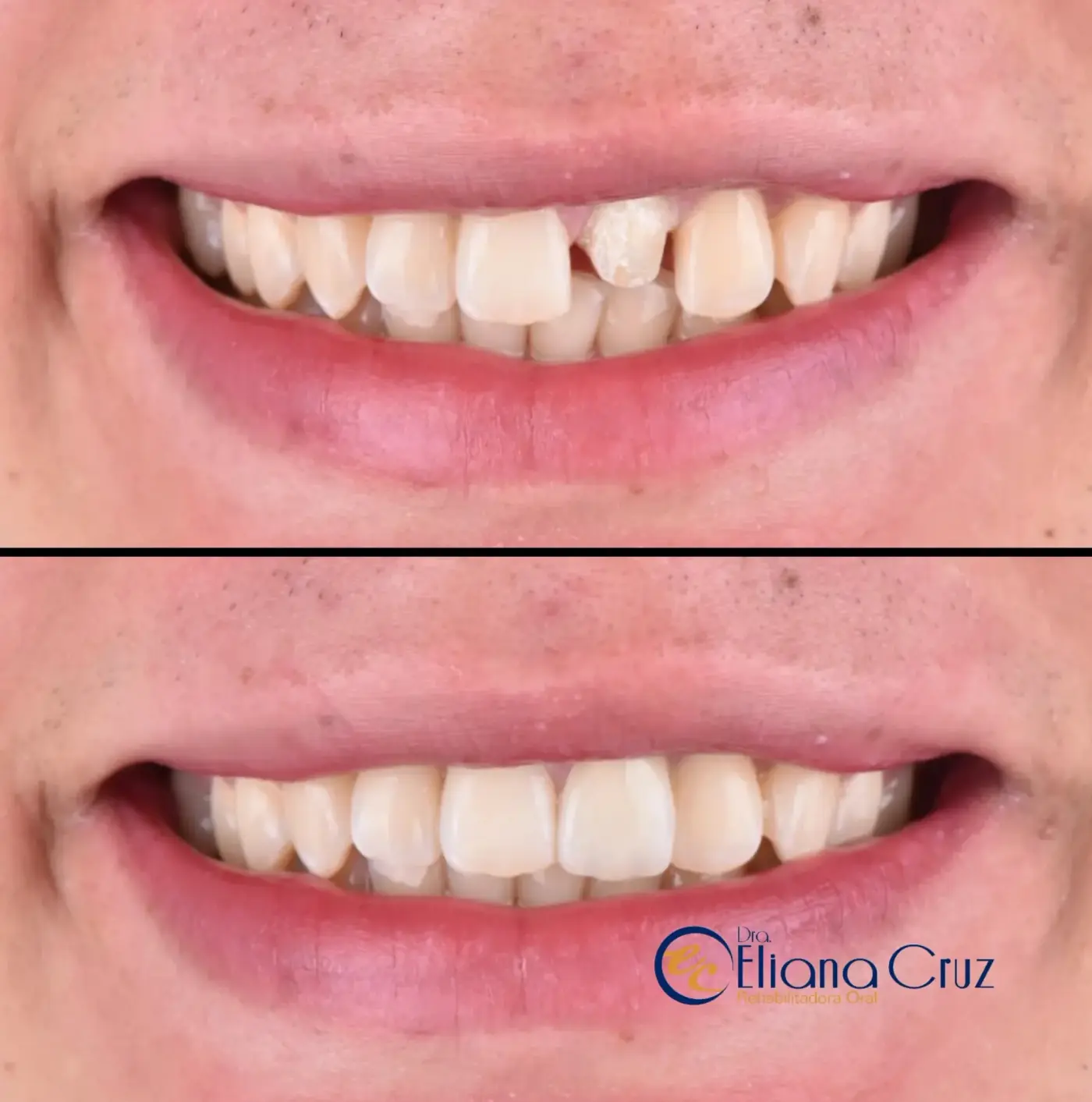 Antes y después de corona individual en cerámica por fractura dental