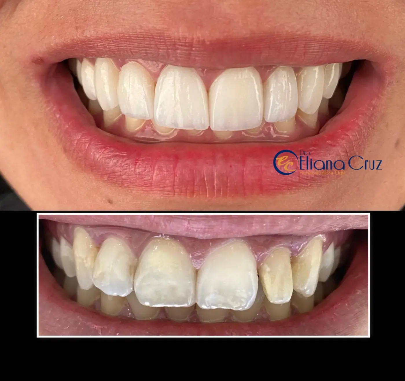 Antes y después de diseño de sonrisa con carillas y coronas superiores