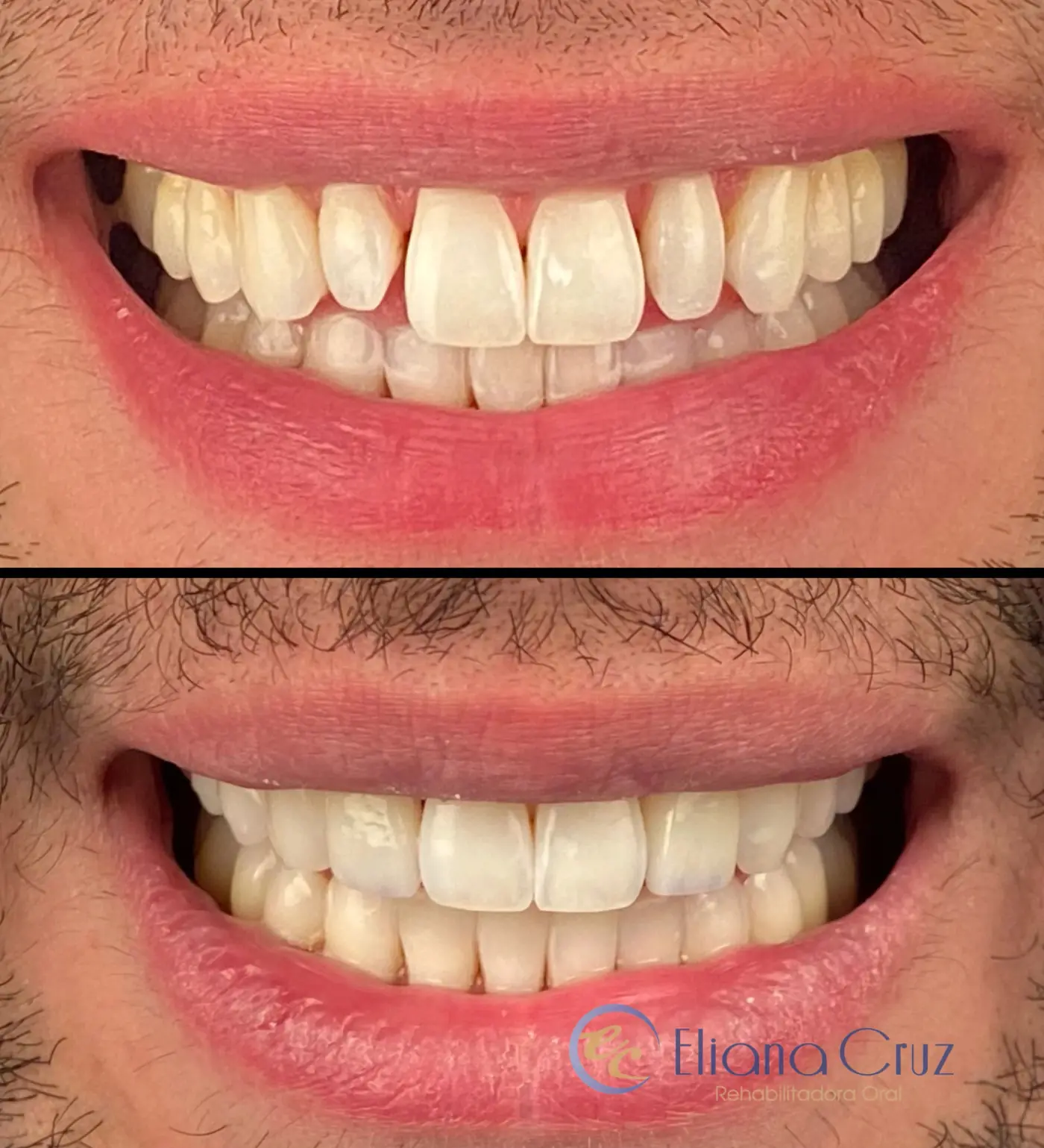Antes y después de carillas cerámicas para microdoncia
