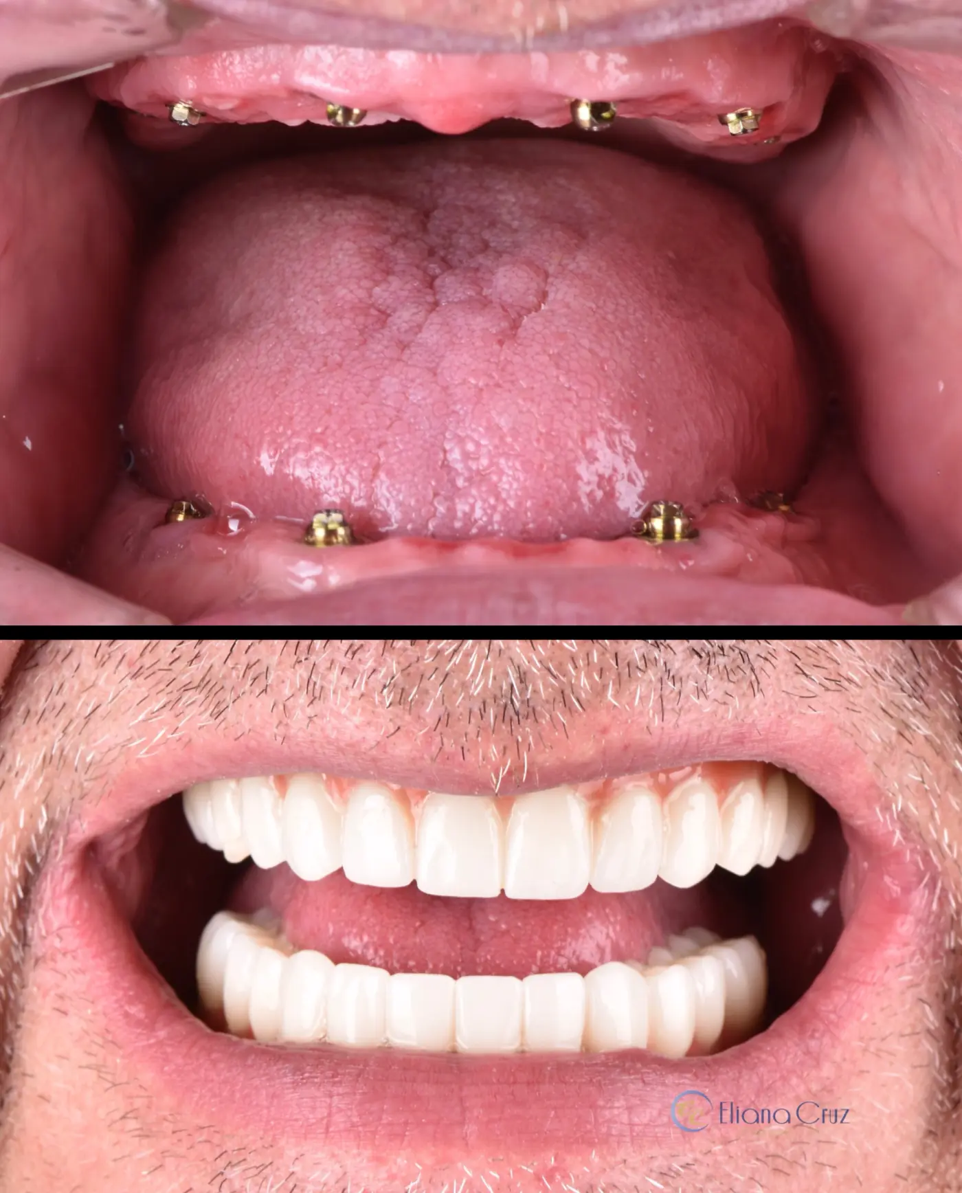 Antes y después de rehabilitación con prótesis fijas sobre implantes