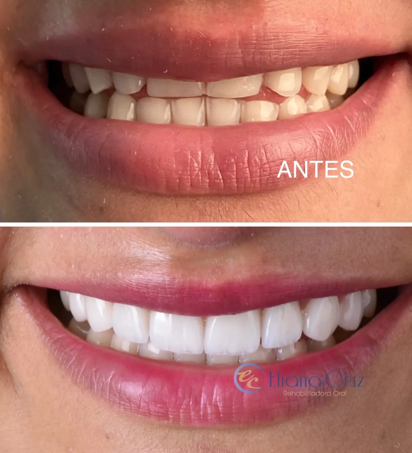 Antes y después de diseño de sonrisa con blanqueamiento y carillas