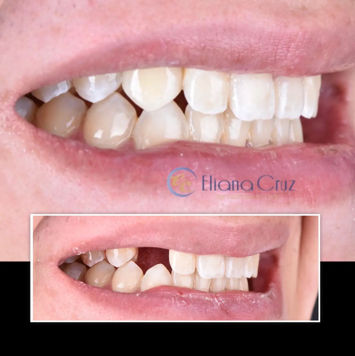 Antes y después de corona cerámica individual sobre implante